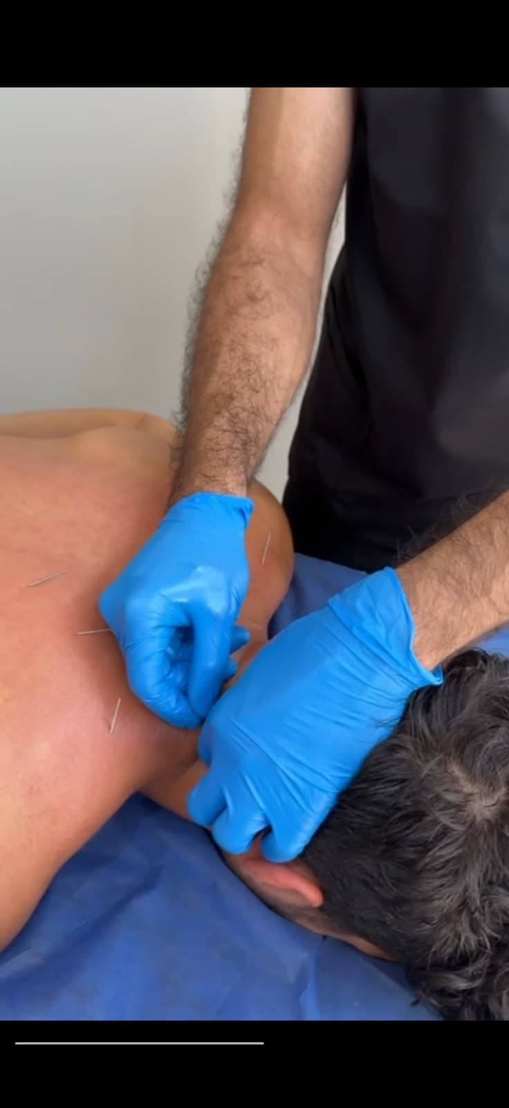 جلسة إبر جافة لعضلات الكتف والرقبة داخل Oriana Clinic