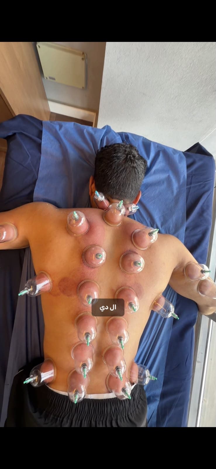 جلسة حجامة علاجية داخل Oriana Clinic